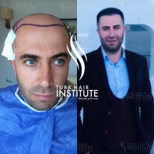 turk-hair-before-after-14